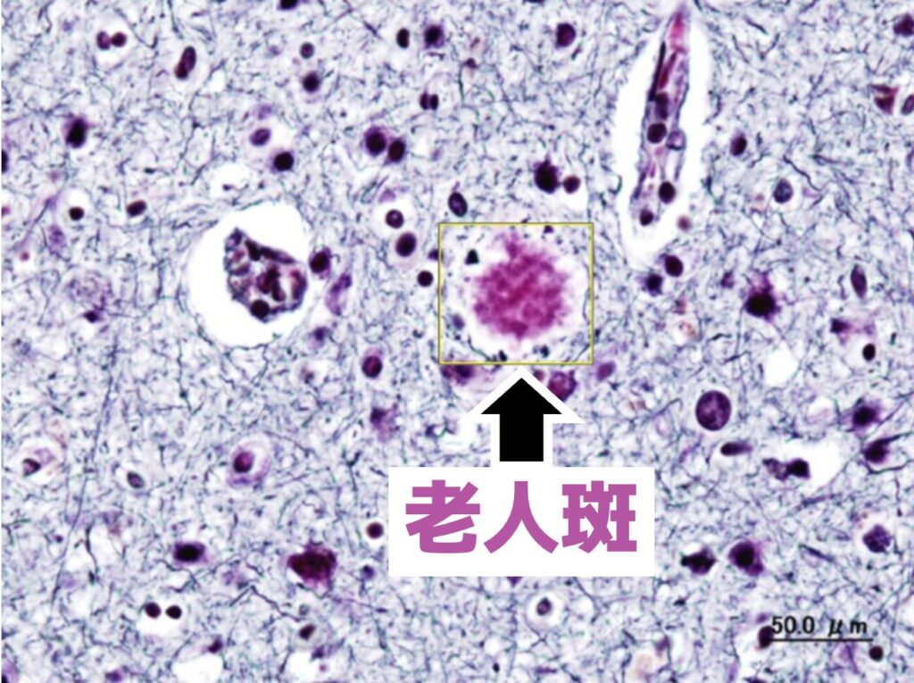 ボディアン染色の老人斑