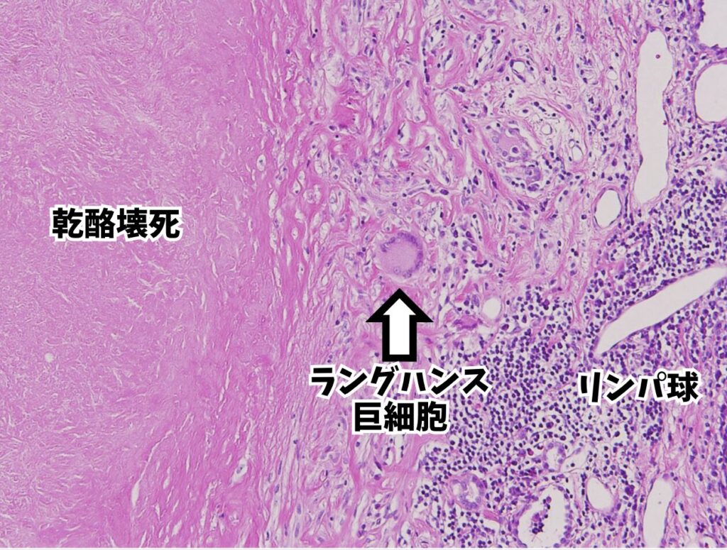 結核の組織像