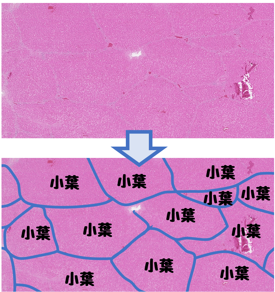 HE低倍率像の肝組織に、グリソン鞘由来の結合組織が入り込み小葉境界を形成する様子を青線で示した模式図。