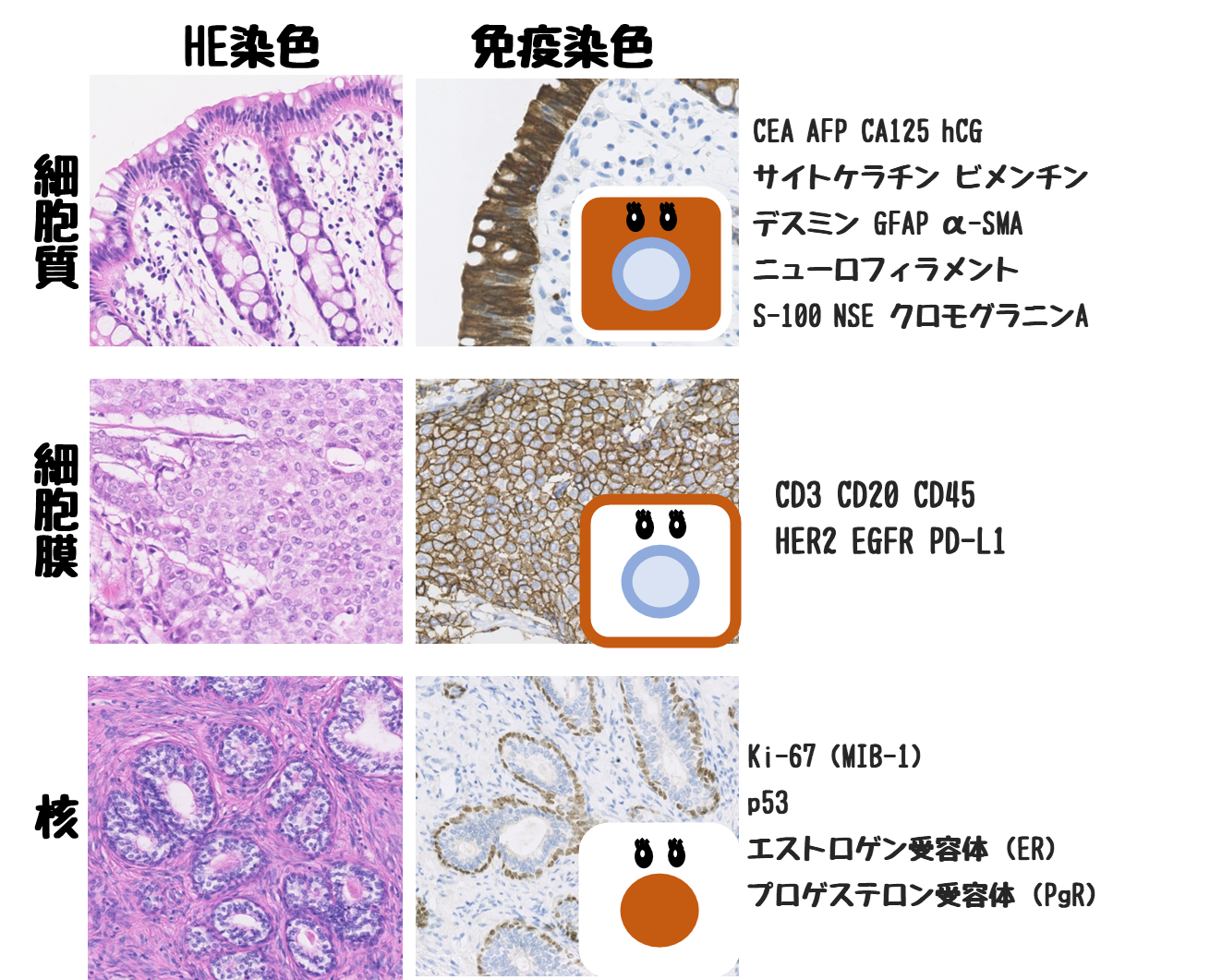 免疫染色 マーカー と局在+覚えるべき関連疾患を絞って紹介【国試対策用】 どっと. New life