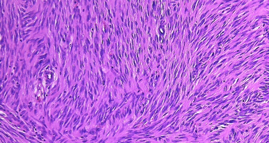 GISTの組織像
出典:twitter@pathology walker