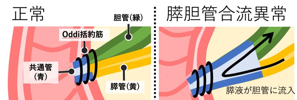 膵胆管合流異常症を示す図