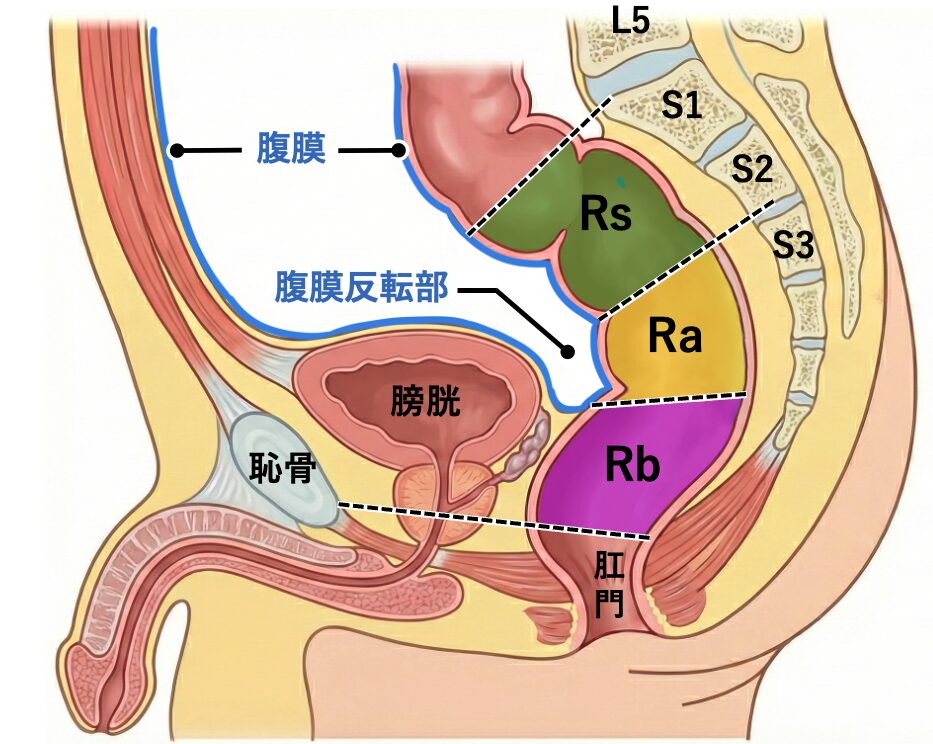 直腸の区分（Rs・Ra・Rb）を示した男性骨盤の矢状断イラスト。仙骨（S1-S3）との位置関係や、腹膜反転部がRaとRbの境界であることが描かれている。Rbは腹膜に覆われておらず、前方に膀胱・前立腺が位置している。