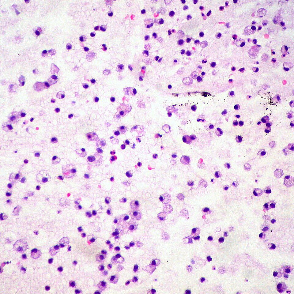 粘液嚢胞（mucocele）の間質内に見られる粘液貪食細胞（muciphages）の顕微鏡写真。HE染色。泡状の細胞質を持つマクロファージが、漏出した粘液を貪食して集まっている様子。Ed Uthman氏撮影 (CC BY 2.0)。